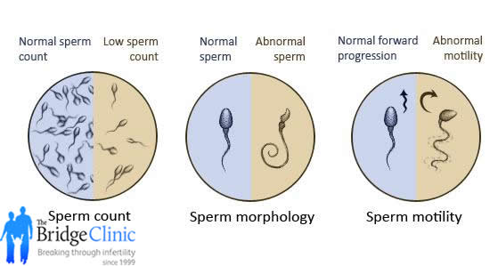Sperm affected g brett wife baby